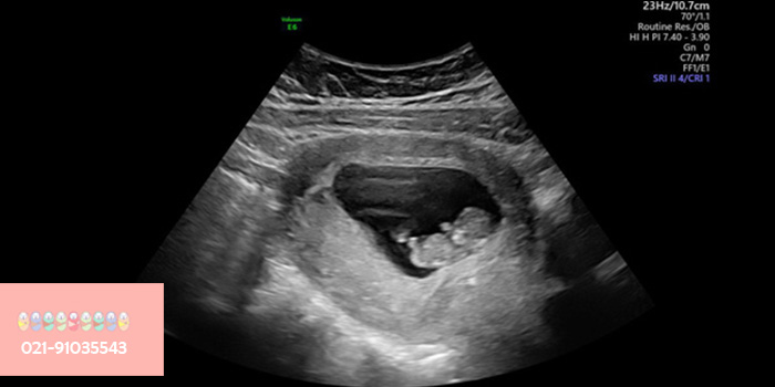 سونوگرافی-جنین-در-هفته-دهم-حاملگی