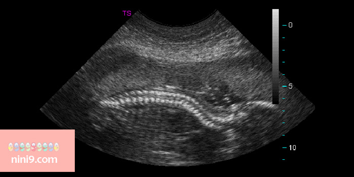 سونوگرافی-در-هفته-31-بارداری