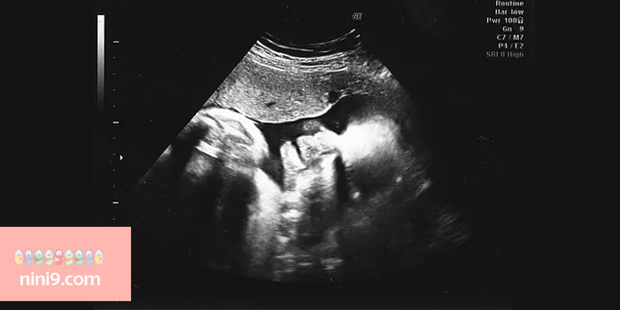 سونوگرافی-در-هفته-سی-و-پنجم-بارداری