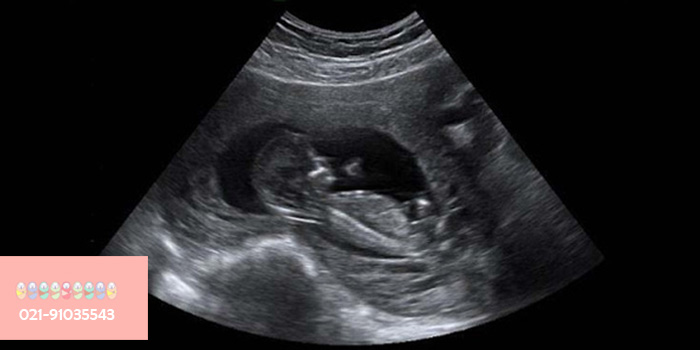 سونوگرافی-سیزدهمین-هفته-بارداری