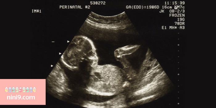 سونوگرافی-هفته-بیست-و-سوم-بارداری