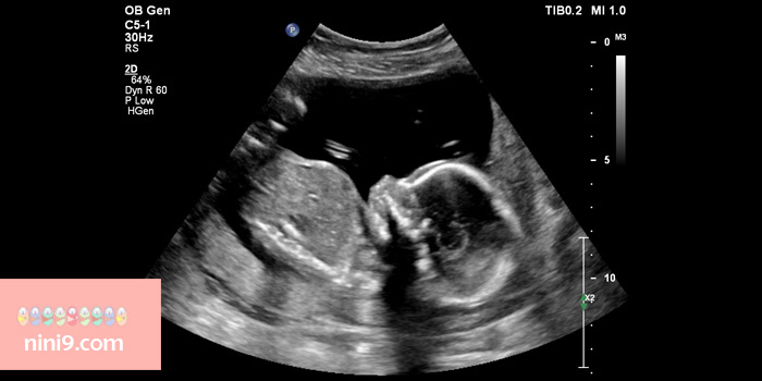 سونوگرافی-هفته-بیستم-بارداری