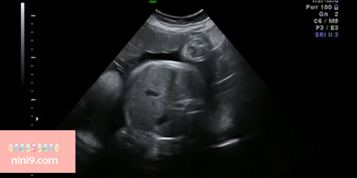 سونوگرافی-هفته-سی-و-ششم-بارداری