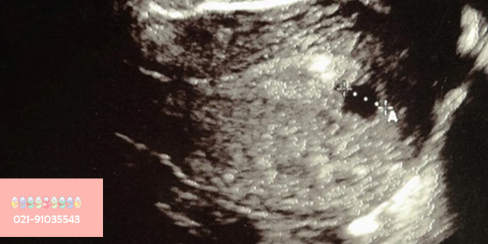 سونوگرافی-هفته-ششم-بارداری