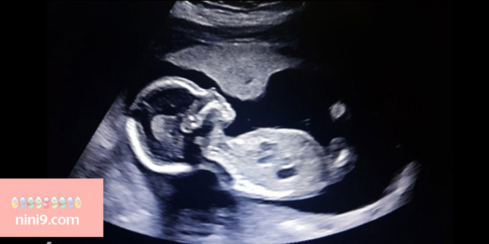 سونوگرافی-هفته-نوزدهم-بارداری
