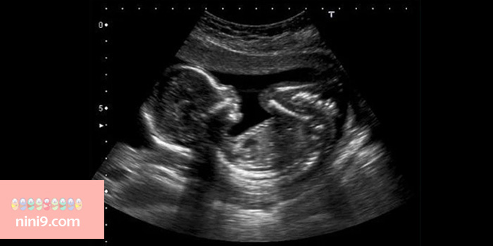 سونوگرافی-هفته-هجدهم-بارداری
