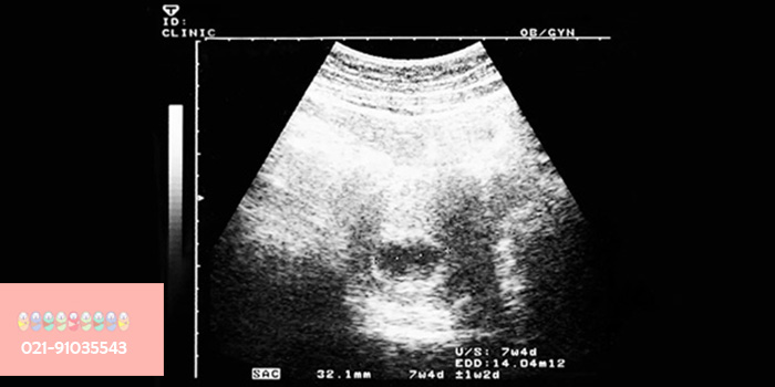 سونوگرافی-هفته-هفتم-بارداری
